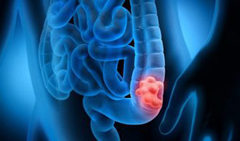 hadassah-cancer-specialists-explore-link-between-colorectal-cancer-thumb